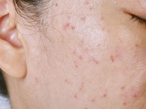 Scar Less, Smile More A Personalized Acne Scar Treatment Plan