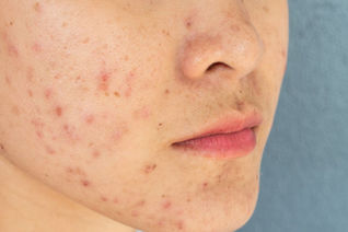 Depth Guide to Skin Renewal, Results, and What to Expect