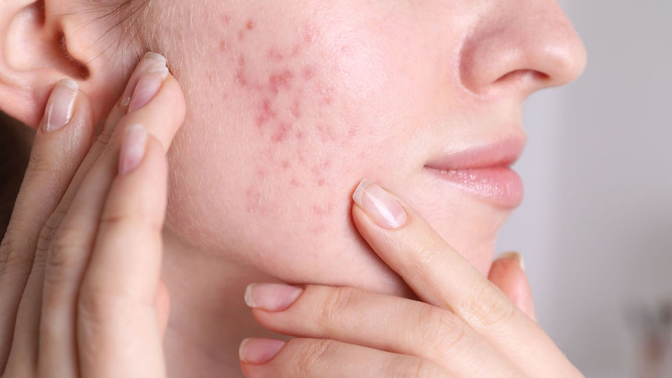 Acne Treatments That Actually Work for Calgary Skin