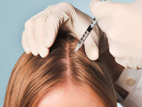 Mesotherapy-For-Hair-Growth-ss.jpeg