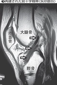 前十字靭帯の再建手術後