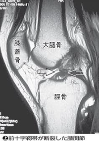 前十字靭帯の断裂