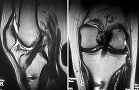 断裂後の前十字靭帯を手術したMRI