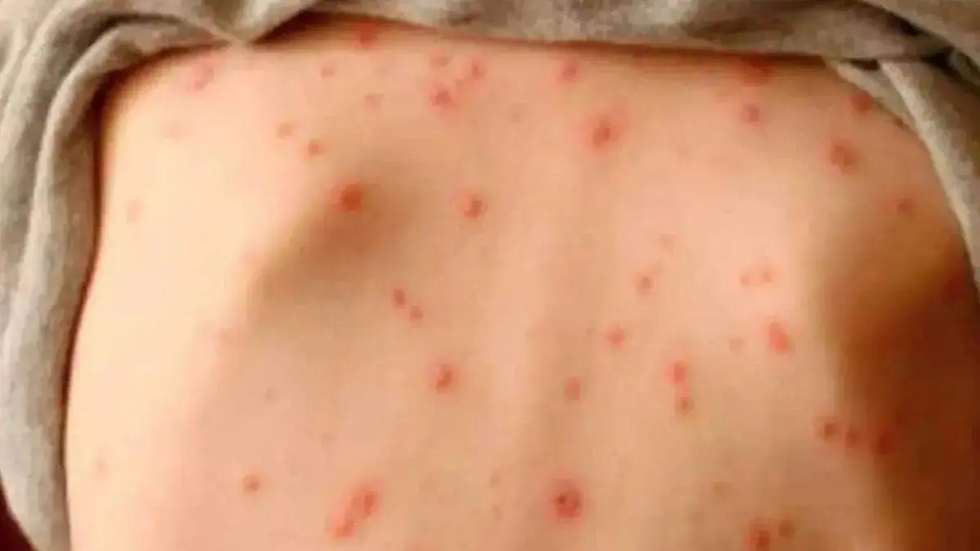 Actualización sobre el brote de sarampión en el estado de Puebla