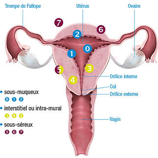 different-types-of-fibroids1.jpeg