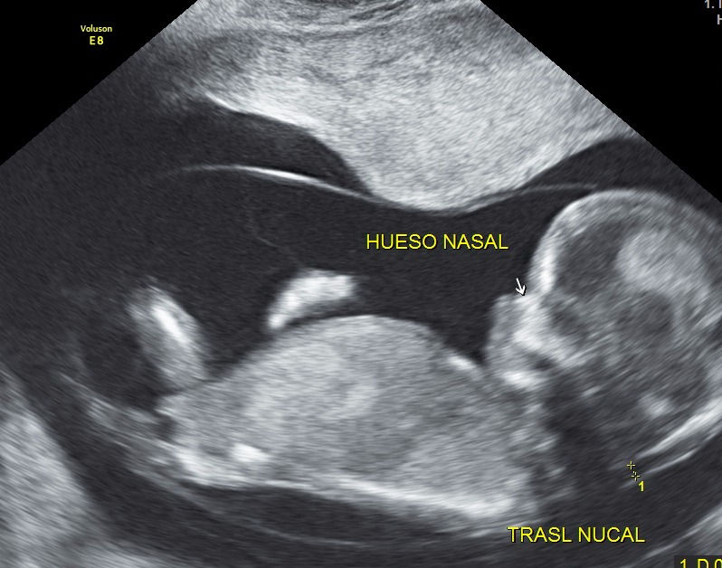 hueso nasal y translucencia nucal