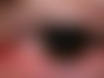 Photokératite : quand le soleil brûle les yeux sans prévenir