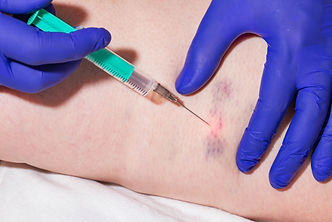 Doctor makes sclerotherapy injection into patient's damaged veins, thrombosis and bruises.