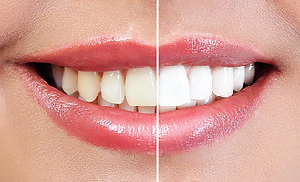 Demonstration of dental whitening result