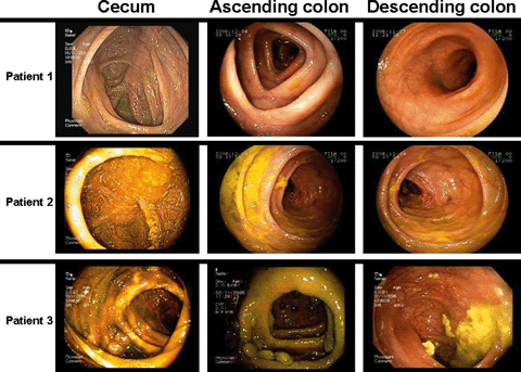 colonoscopy.gif