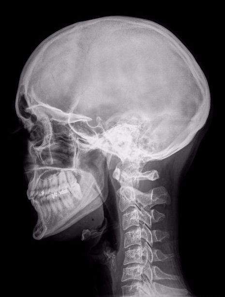 cervical x-ray diagnosis