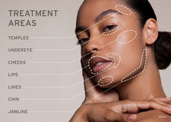 juvederm-treatment-areas-1024x732