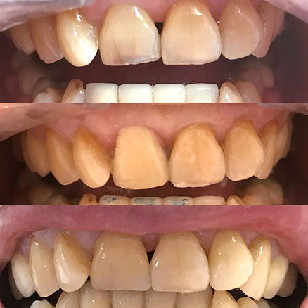 avant/après facettes dentaires. correction défauts sur les dents
