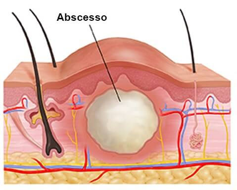 Drenagem abscesso