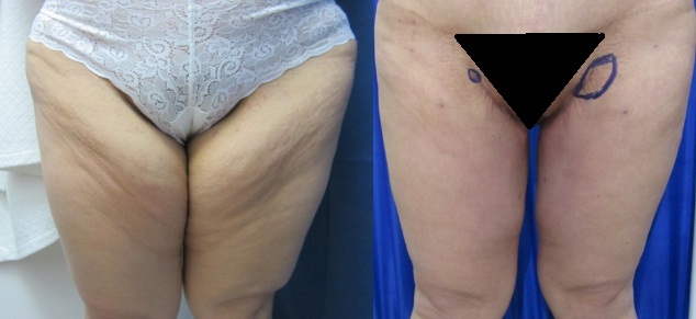 Lipo Vaser y lifting de muslos