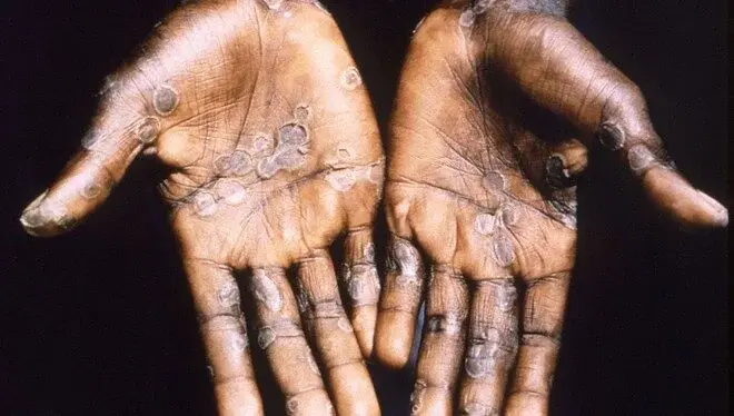 Dünya Sağlık Örgütü, Afrika'da birçok ülkeye yayılan maymun çiçeği virüsü nedeniyle iki yıl içinde ikinci kez küresel halk sağlığı acil durumu ilan etti. Kongo Demokratik Cumhuriyeti’nden komşu ülkelere yayılan maymun çiçeği virüsü nedeniyle Dünya Sağlık Örgütü (DSÖ), harekete geçti. Kongo Demokratik Cumhuriyeti’nden komşu ülkelere yayılan maymun çiçeği virüsü nedeniyle Dünya Sağlık Örgütü (DSÖ), harekete geçti. İçeriği oku Burundi, Kenya, Ruanda ve Uganda’da da virüsün yayılması sonucu DSÖ, maymun çiçeği virüsü nedeniyle iki yıl içinde ikinci kez küresel halk sağlığı acil durumu ilan etti. DSÖ Genel Direktörü Tedros Adhanom Ghebreyesus, “Bu salgınları durdurmak ve hayat kurtarmak için koordineli bir uluslararası müdahalenin şart olduğu açıktır” dedi. Küresel halk sağlığı acil durumu, DSÖ’nün en yüksek alarm seviyesi olarak biliniyor ve bir hastalığı kontrol altına almak için araştırma, finansman, uluslararası halk sağlığı önlemlerini ve işbirliğini hızlandırmayı amaçlıyor. AFRİKA'DA DÜN "ACİL DURUM" İLAN EDİLMİŞTİ Afrika Hastalık Kontrol ve Önleme Merkezleri (Africa CDC), dün Kongo Demokratik Cumhuriyeti’nden komşu ülkelere yayılan maymun çiçeği virüsü nedeniyle kıta genelinde "halk sağlığı acil durumu" ilan etmişti. Africa CDC, bu yıl kıtada şimdiye kadar maymun çiçeği kaynaklı 17 binden fazla vaka ve 517 ölüm rapor edildiğini aktararak, bunun geçen yılın aynı dönemine göre yüzde 160'lık bir artışı temsil ettiğini söyledi. Afrika’da toplam 13 ülkede vaka bildirdi. İLK KEZ İNSANLARDA 1970'DE TESPİT EDİLDİ Maymun çiçeği, 1970 yılında Kongo Demokratik Cumhuriyeti’nde insanlarda ilk kez tespit edildikten sonra onlarca yıldır Afrika'nın bazı bölgelerinde endemik olarak görülüyor. Virüsün daha hafif bir varyantı, 2022 yılında, büyük ölçüde cinsel temas yoluyla 100’den fazla ülkeye yayıldı ve Dünya Sağlık Örgütü'nün (DSÖ) en yüksek alarm seviyesi olan küresel halk sağlığı acil durumu ilan etmesine neden olmuştu. DSÖ, 10 ay sonra sağlık krizinin kontrol altına alındığını söyleyerek acil durumu sona erdirmişti.
