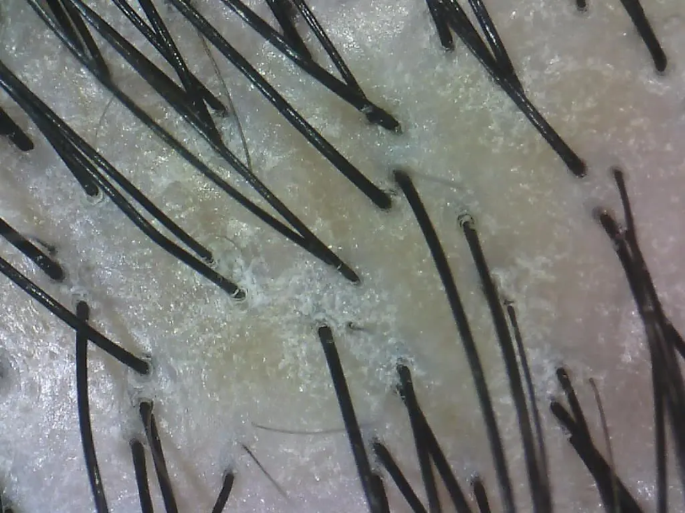 Close-up view of black hair strands on a light scalp. The image shows pores and hair follicles, creating a detailed texture against pale skin.