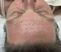 Anwendung Plasmatherapie (Eigenblut)
