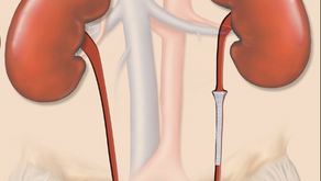 From Relief to Resilience: Unraveling the Benefits of Metallic Ureteric Stents.