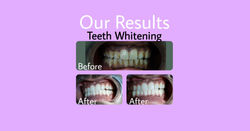 Our Results - Teeth Whitening