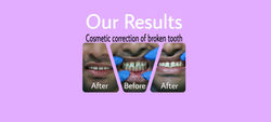 Our Results - Broken tooth corrected by cosmetic filling