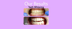 Our Results - Teeth Whitening