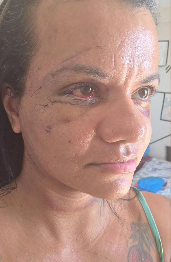 Juliana Soares, vítima de agressão com 60 socos, mostra recuperação após cirurgia facial