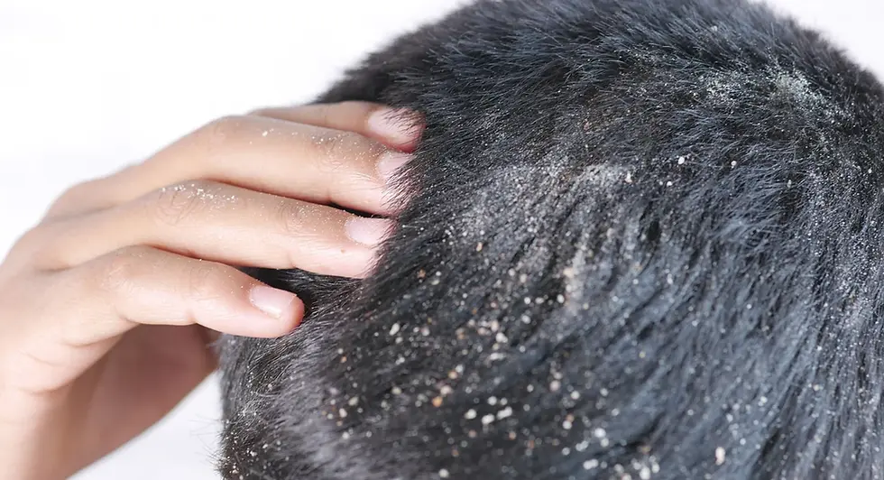 Πιτυρίδα: από τι προκαλείται και πώς αντιμετωπίζεται σωστά