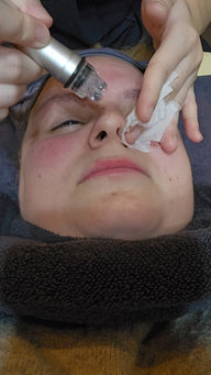 Aqua Peel: A deep-cleansing procedure that removes impurities and hydrates the skin, leaving it refreshed and revitalized.