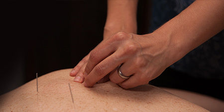 acupuncture-and-cupping.jpeg