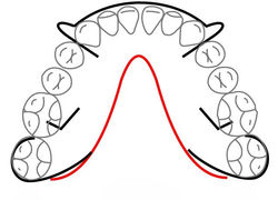 Mandibular w/C's Clasps