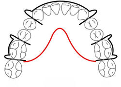 Mandibular w/Adams Clasps