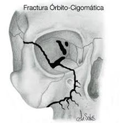 fractura orbitaria