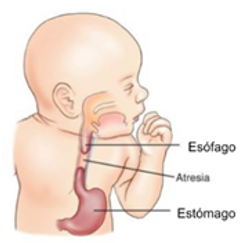 Malformacion congénita