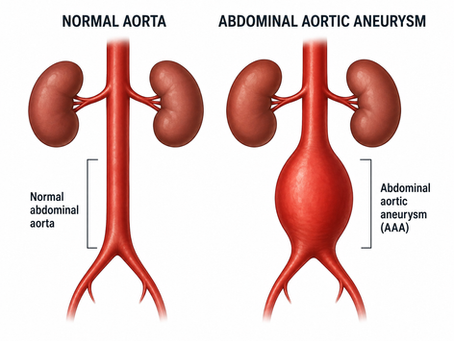 Abdominal Aortic Aneurysms (AAA)