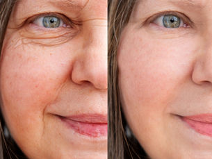 Why More People Are Choosing Wrinkle Treatment Clinics for Anti-Aging Results