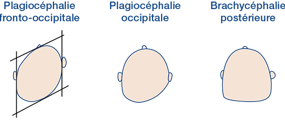 figure_1_plagiocephalie_edited.png