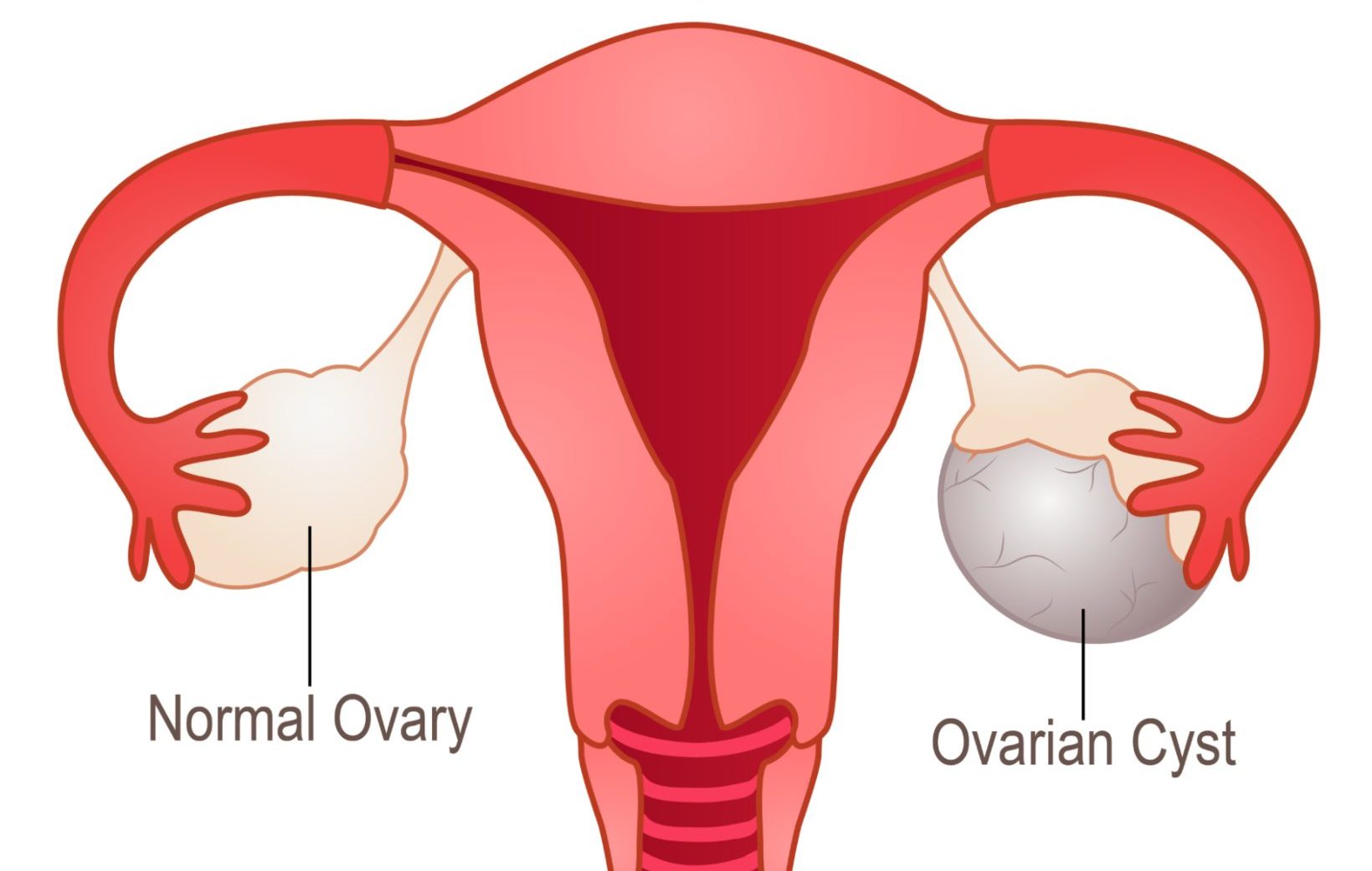 Ovarian Cystectomy and Normal Ovary Diagram