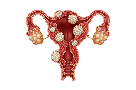 Myomectomy Surgery and Uterine Fibroids