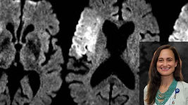 When the Lesion Doesn't Tell the Whole Story: Rethinking Dysphagia After Stroke