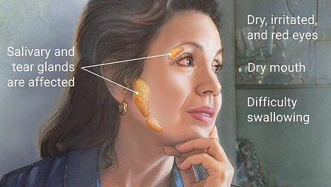sjogren's syndrome