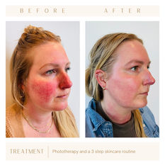 IPL therapy before & after / Phototherapy / laser skin rejuvenation / BBL