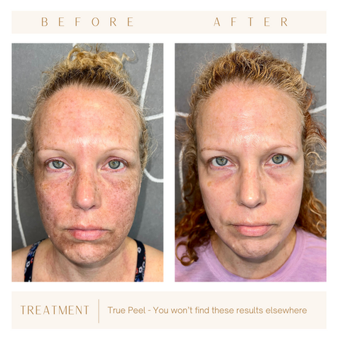 Phenol TCA chemical peel / jessner peel before & after