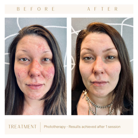 IPL before & after / laser skin rejuvenation / phototherapy / bbl broadband light