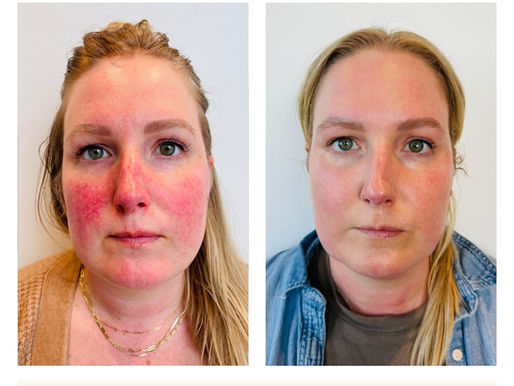 Treating Rosacea