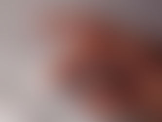 繰り返すマウス クリックで起きた腕の痛み｜40代男性の鍼治療例
