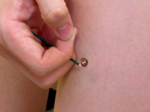 皮膚の上に小さなもぐさを置いて燃やす直接灸の写真