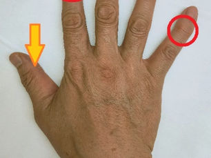 左手の指を示す写真で、既存のへバーデン結節と今回痛みが出た部位がマークされている。