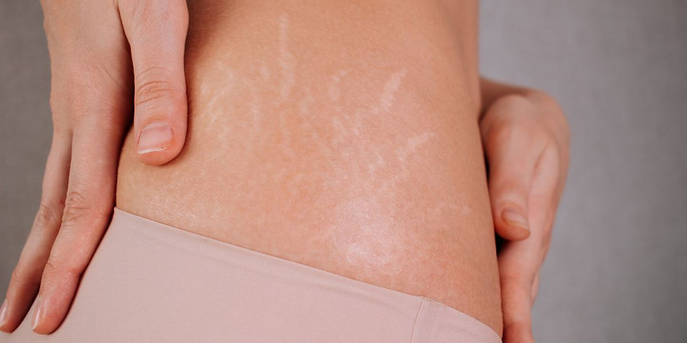 A woman with stretch marks