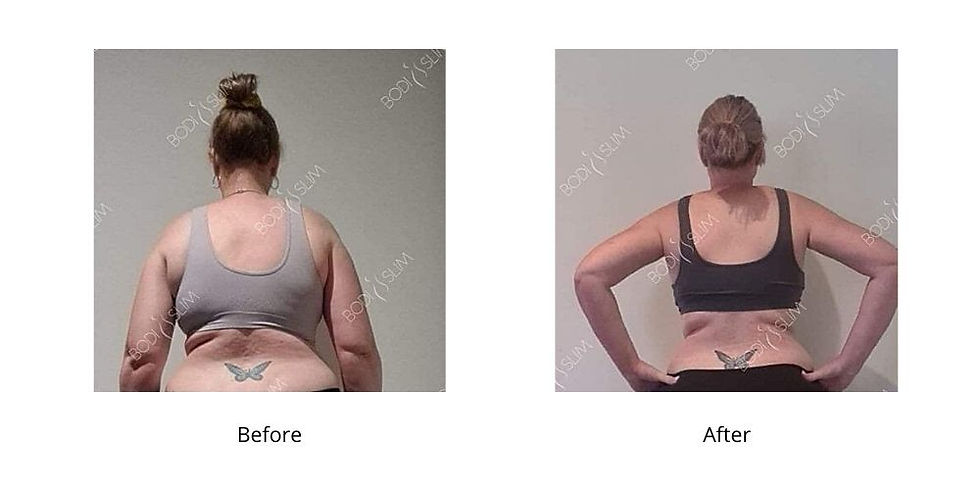 A before and after image of a client at the Bodi Slim fat freezing salon